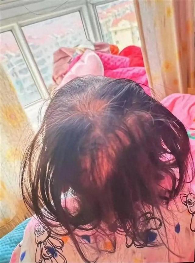 3岁女童脱发被查出铊中毒 医院回应→